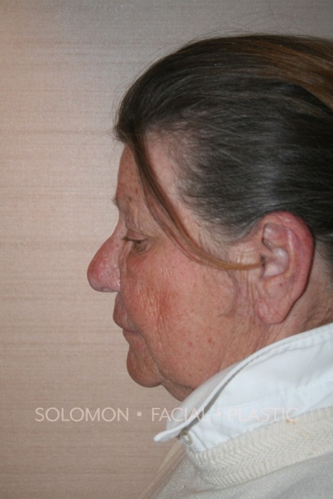 Rhinophyma Before After Photos-2