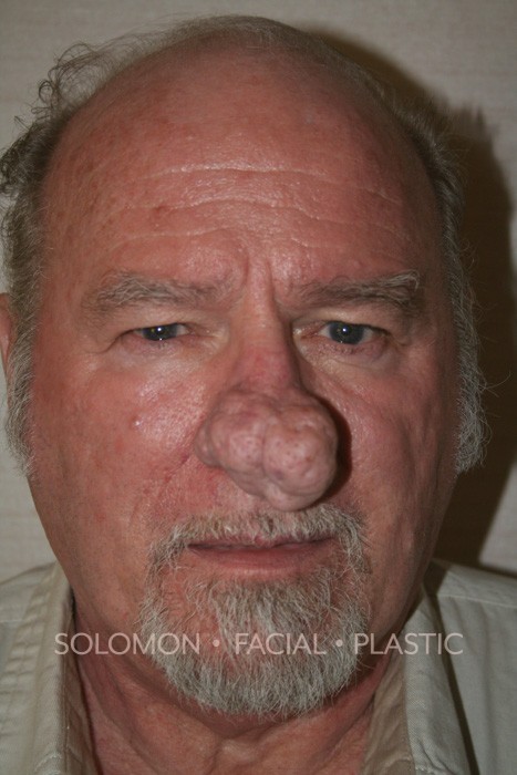 Rhinophyma Before After Photos