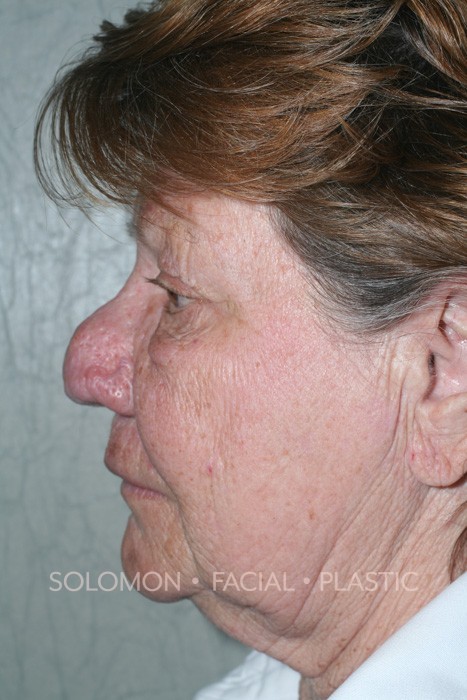 Rhinophyma Before After Photos-2