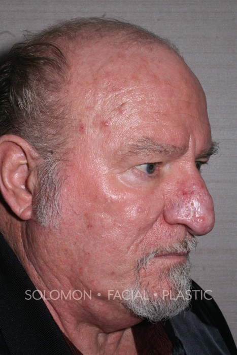Rhinophyma Before After Photos