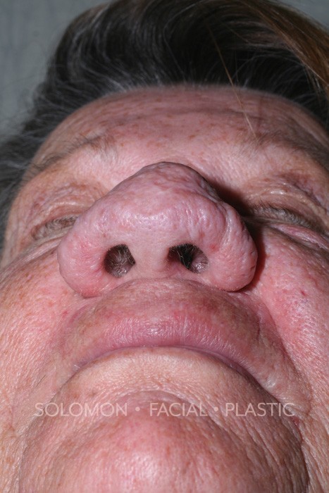 Rhinophyma Before After Photos-2
