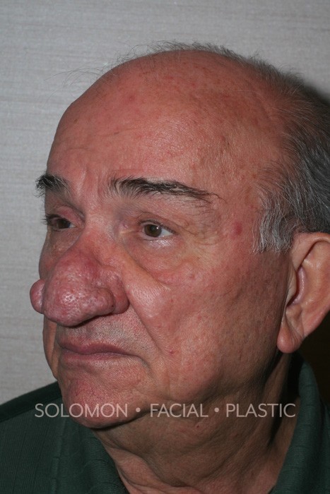 Rhinophyma Before After Surgery