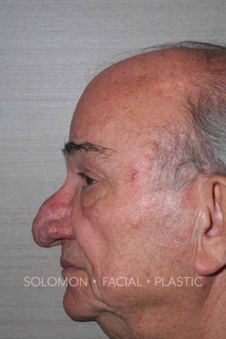 Rhinophyma Before After Surgery