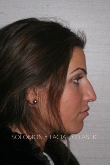 Cosmetic Rhinoplasty Picture Before