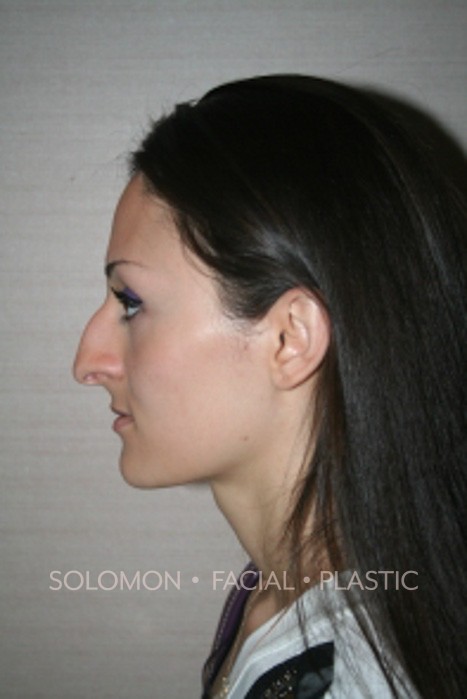 Rhinoplasty Surgery Before After Photos