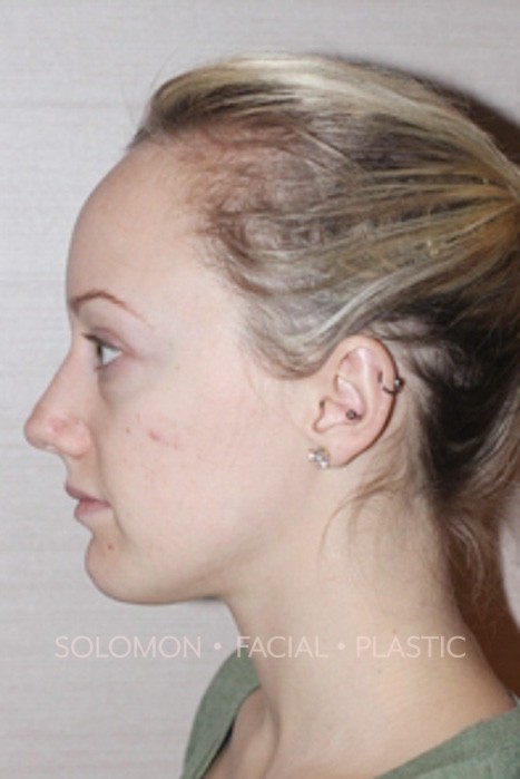 Rhinoplasty Surgery Before After Photos