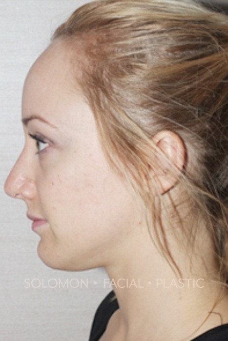 Rhinoplasty Surgery Before After Photos