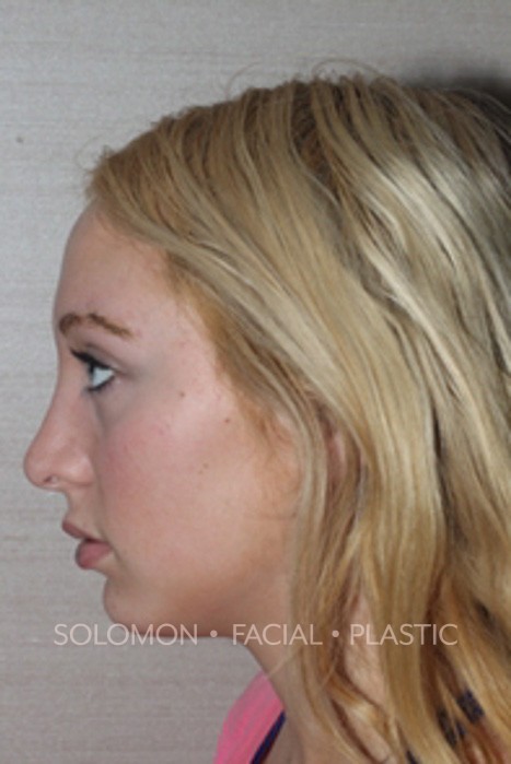 Rhinoplasty Surgery Before After Photos