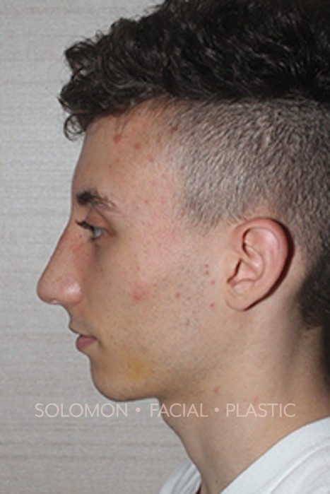 Rhinoplasty Surgery Before After Photos