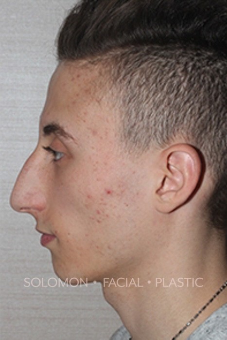 Rhinoplasty Surgery Before After Photos