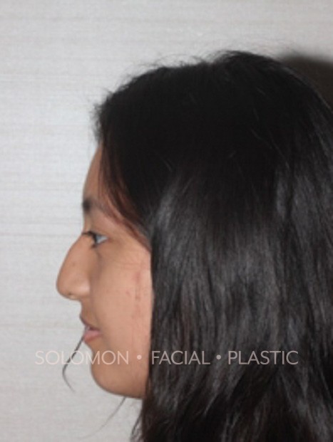 Rhinoplasty Surgery Before After Photos