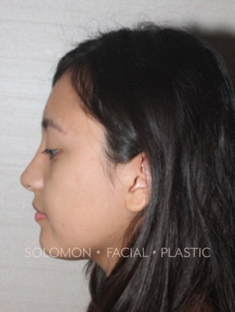 Rhinoplasty Surgery Before After Photos