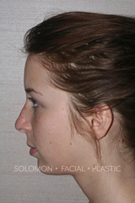 Rhinoplasty Surgery Before After Photos