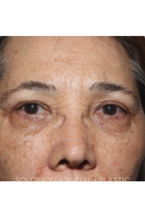 Blepharoplasty Before After Photos