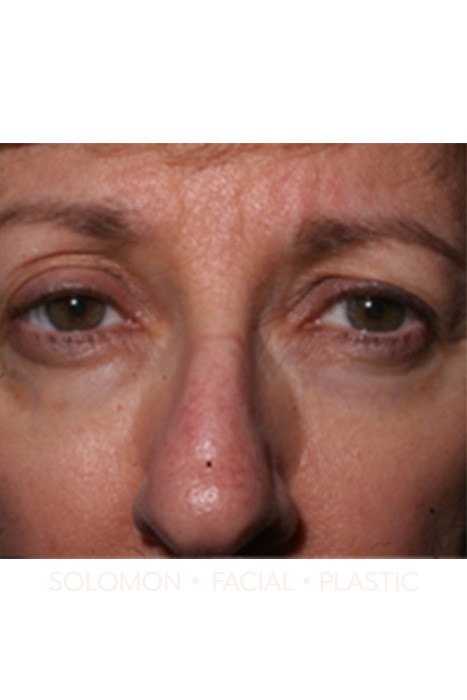 Blepharoplasty Before After Photos