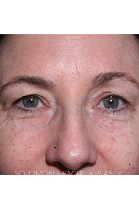 Blepharoplasty Before After Photos