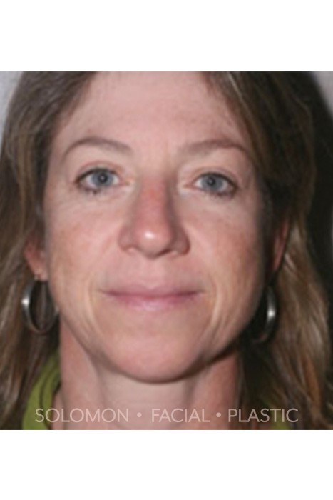 Blepharoplasty Before After Photos