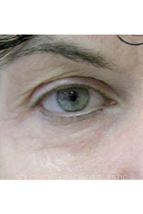 Blepharoplasty Before After Photos