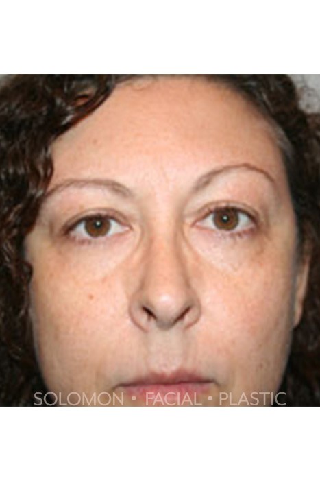 Blepharoplasty Before After Photos