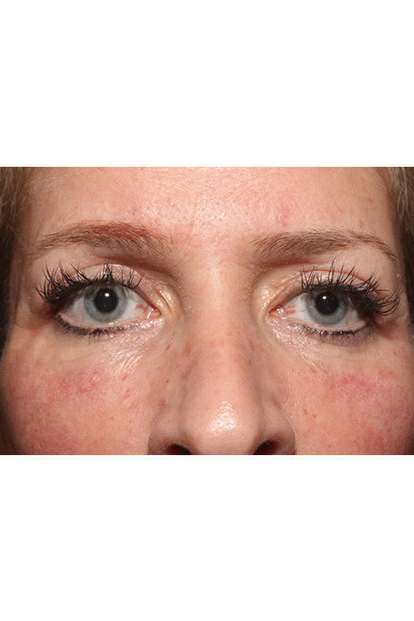 Blepharoplasty Before After Photos