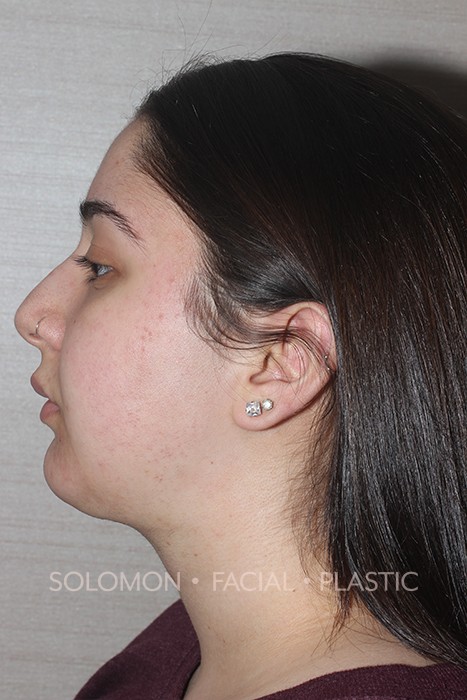 Chin Implant Before After Photos