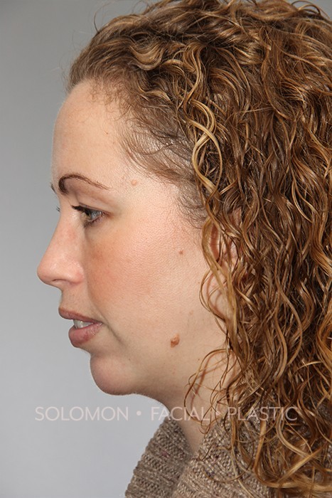 Chin Implant Before After Photos