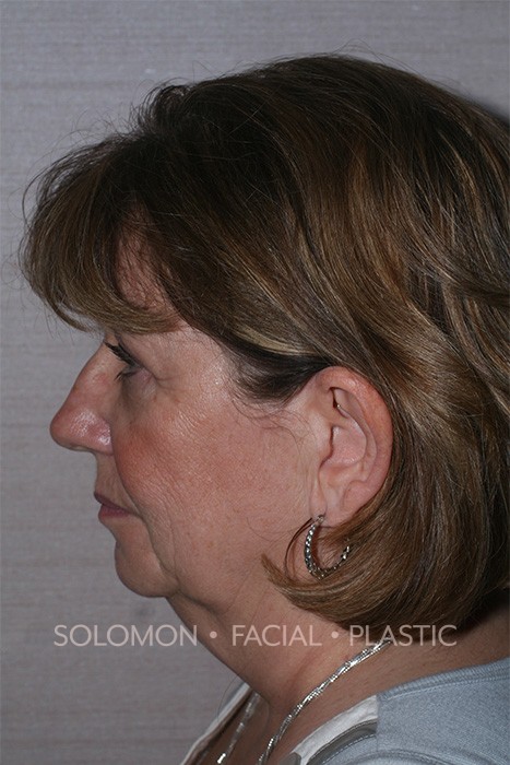 Facelift Before After Photos