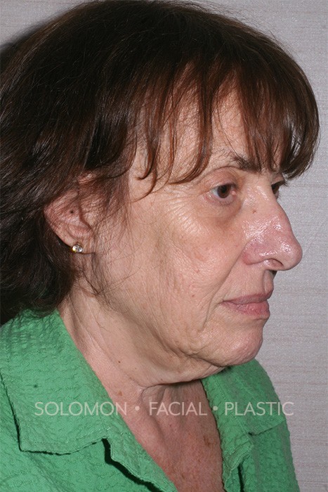 Facelift Before After Photos