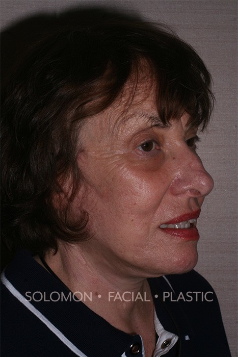 Facelift Before After Photos