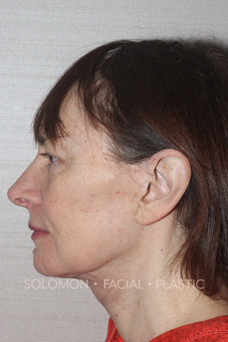 Facelift Before After Photos