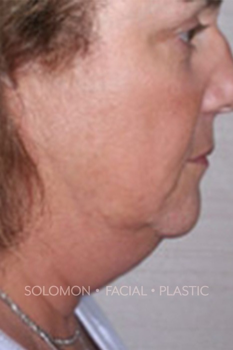 Facelift Before After Photos