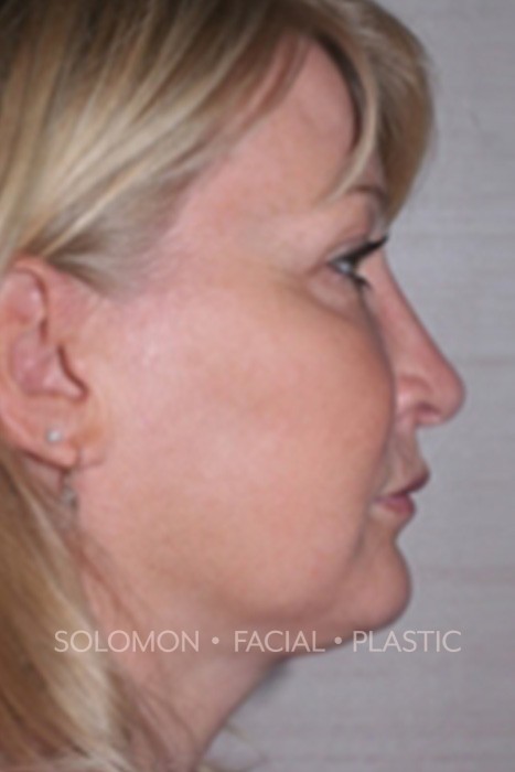 Facelift Before After Photos