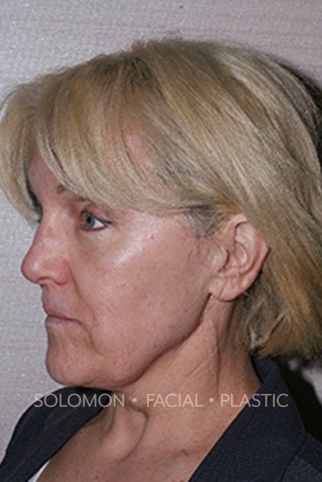 Facelift Before After Photos