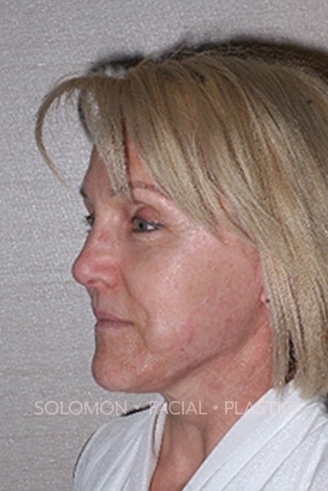 Facelift Before After Photos