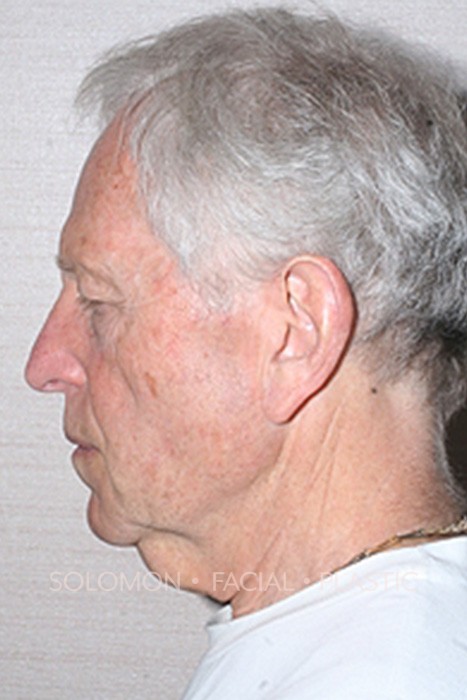 Facelift Before After Photos