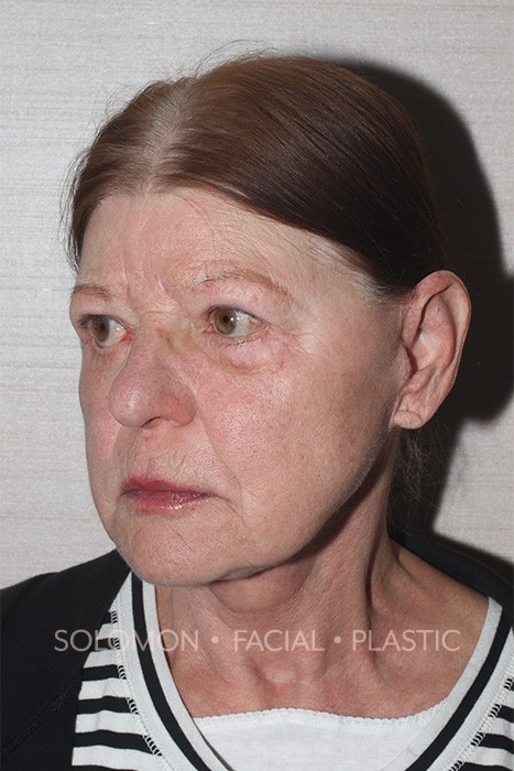 Facelift Before After Photos