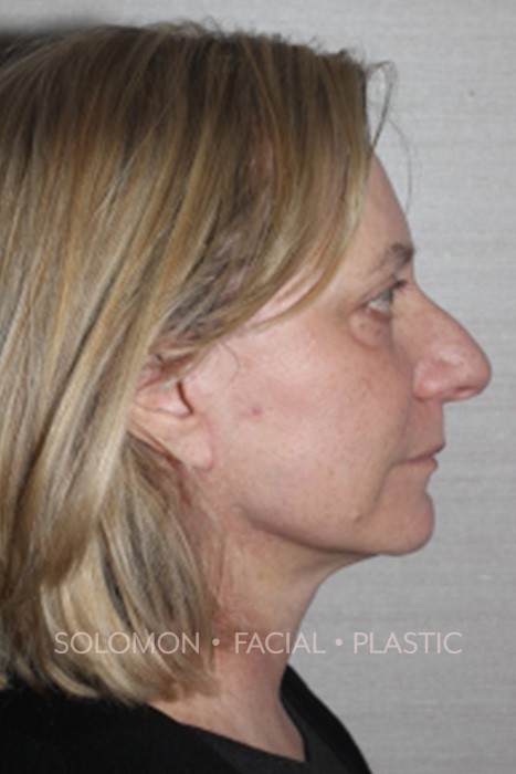 Facelift Before After Photos