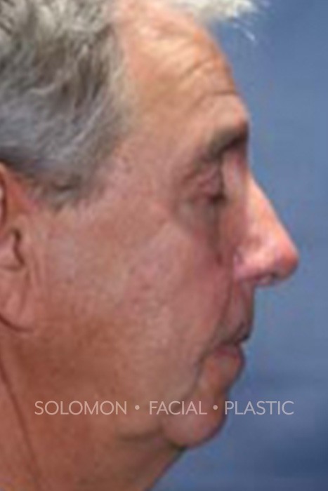 Facelift Before After Photos