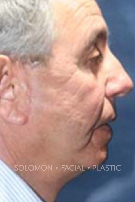 Facelift Before After Photos