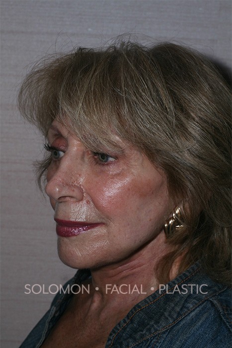 Facelift Before After Photos