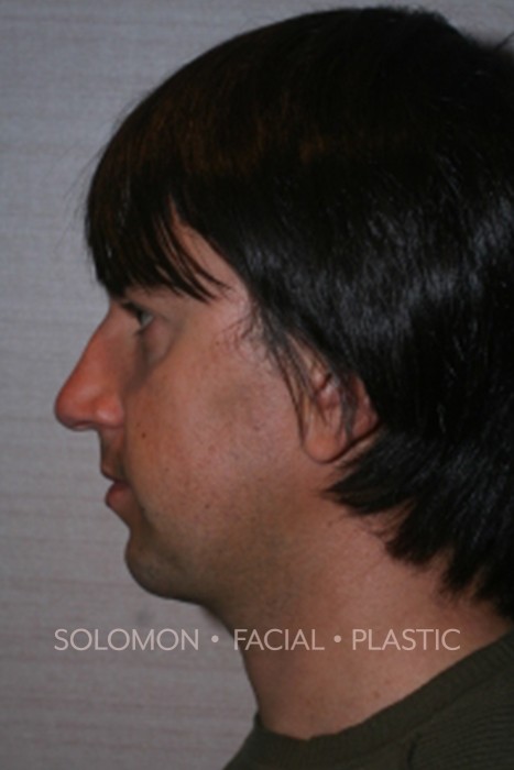 Facial Implants Before After Photos