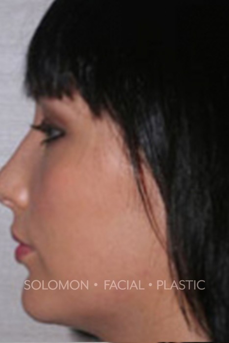 Facial Implants Before After Photos