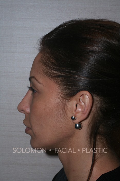 Facial Implants Before After Photos