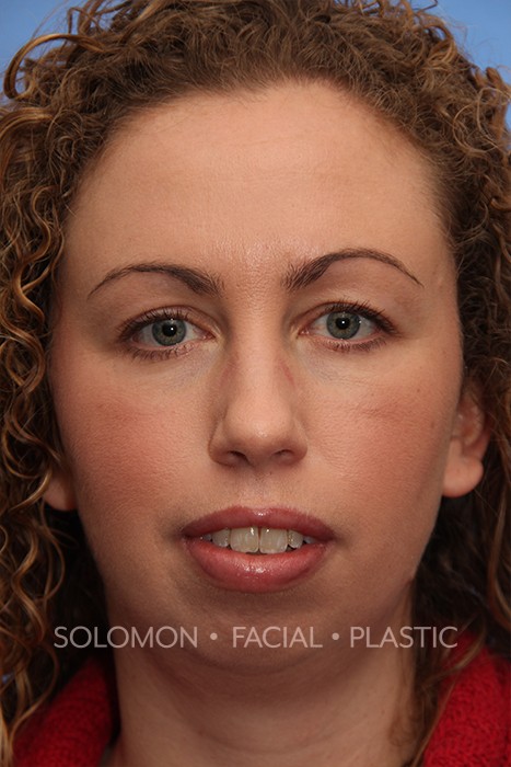 Facial Implants Before After Photos