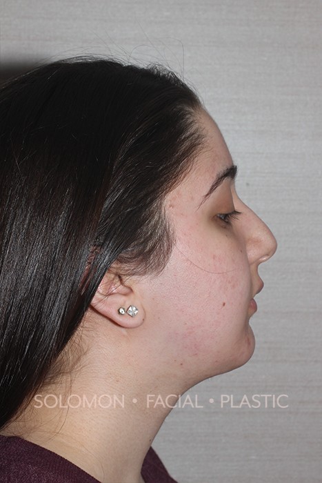 Facial Liposuction Before After Photos