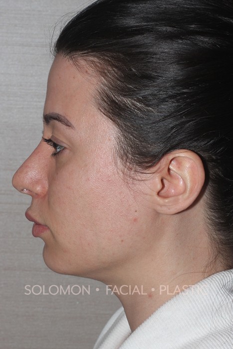 Facial Liposuction Before After Photos