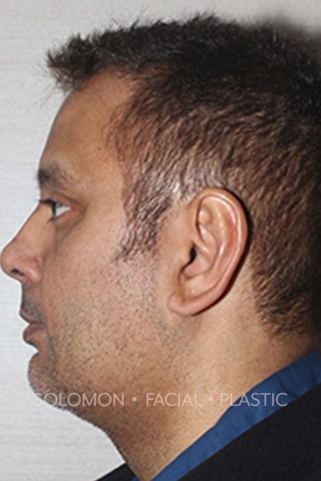 Facial Liposuction Before After Photos