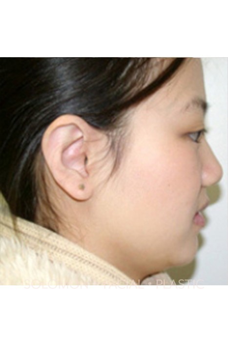 Otoplasty Before After Photos