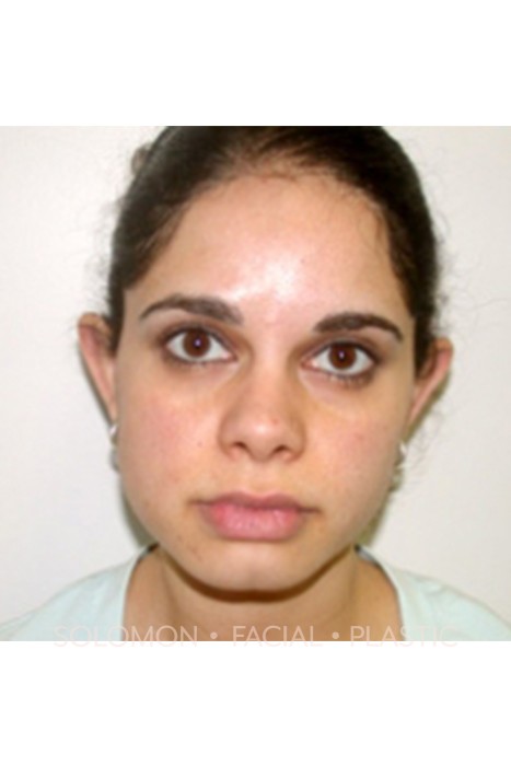 Otoplasty Before After Photos