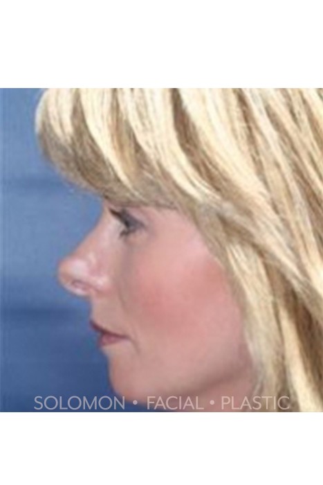 Revision Rhinoplasty Toronto Before After Photos